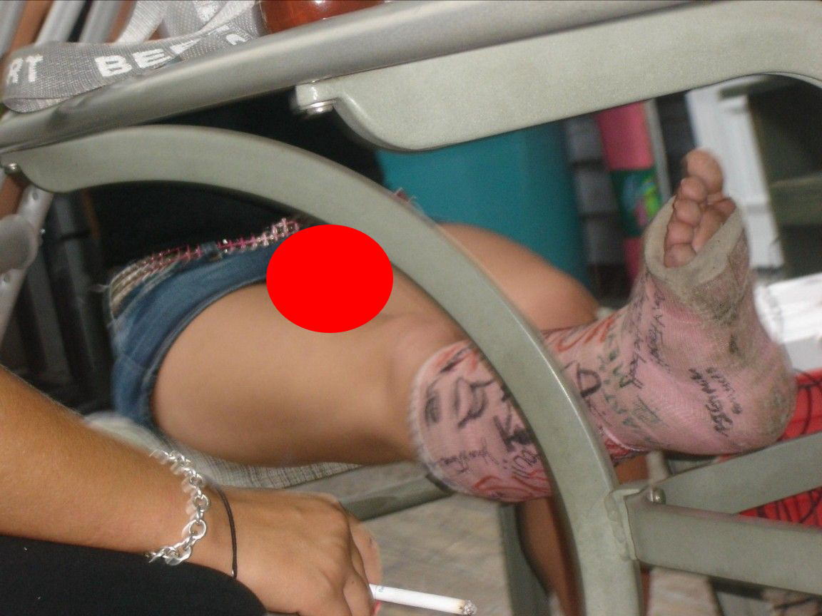 【画像あり】骨折女子がギプスしたらパンチラまで固定された