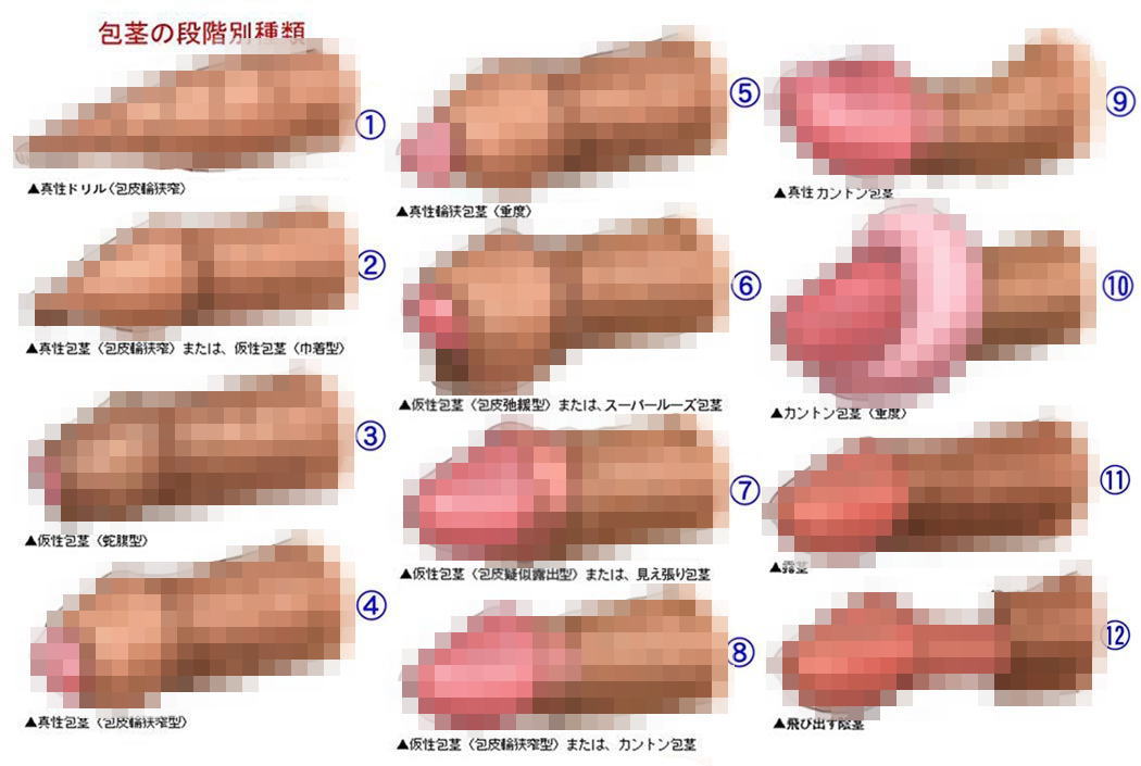 包茎の段階別種類まとめ